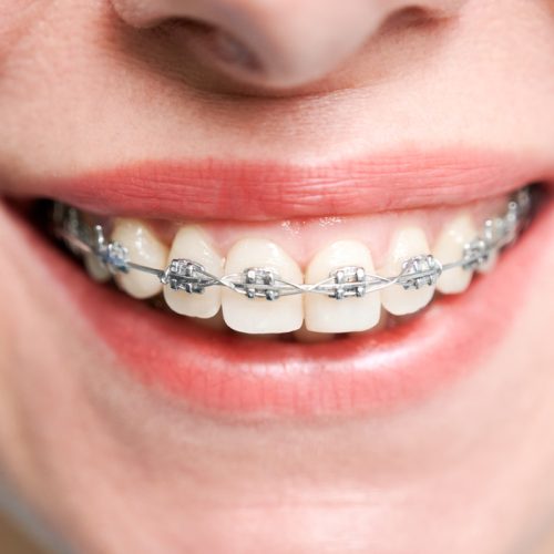 brackets-para-mejorar-tu-sonrisa